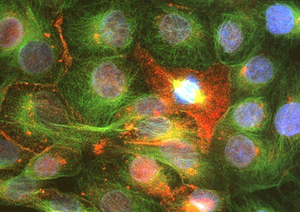 Image: Immunofluorescent light micrograph of prostate cancer cells (Photo courtesy of Nancy Kedersha / SPL).